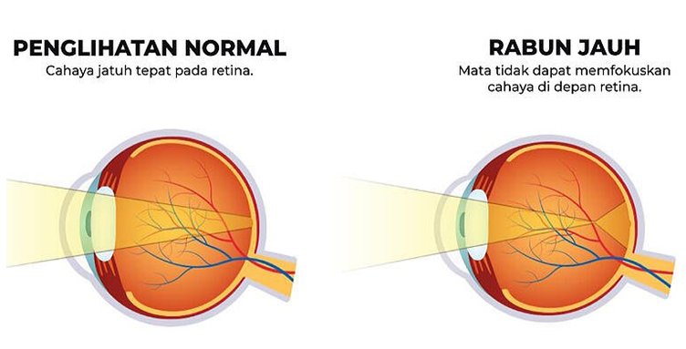 Read more about the article Rabun Jauh (Myopia) Dan Rabun Dekat (Hyperopia)